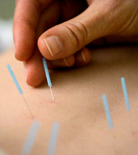 Foto 1 - Mal de parkinson tratamento acupuntura Massagem